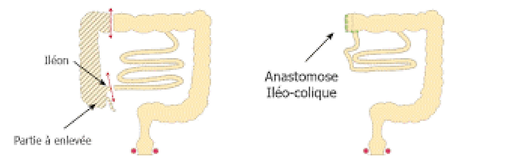 colectomieDroite_1.jpg